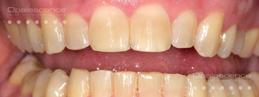 Vor der Anwendung des Opalescence Zahnaufhellungssystems