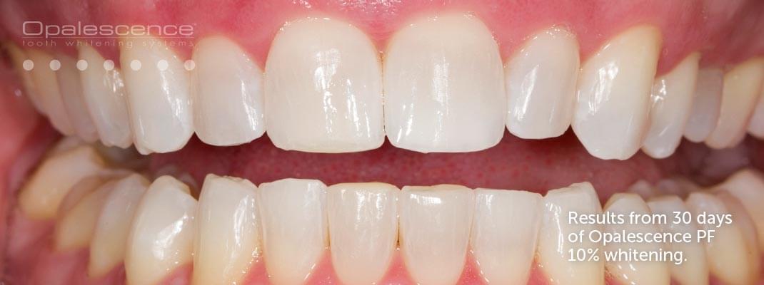 Teeth Whitening After a Root Canal