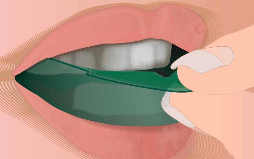 Teeth whitening opalescence instructions
