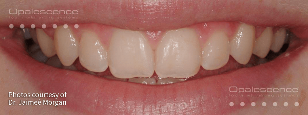 Before Opalescence tooth whitening system