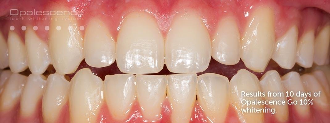 After Opalescence tooth whitening system